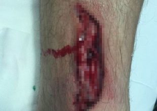 Σοκαριστική φωτογραφία από τον τραυματισμό του Ντόιλ (ΦΩΤΟ)