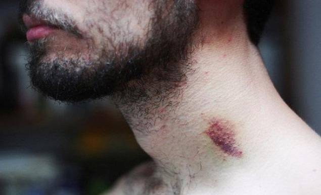 Νεαρός πέθανε μετά από «ρούφηγμα» της φίλης του στο λαιμό!