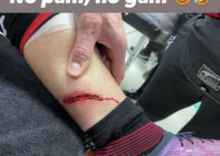 Μ’ αυτήν την τεράστια πληγή αγωνιζόταν από το 24′ στο ντέρμπι ο Ζιρού