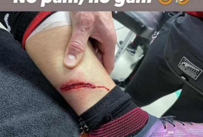 Μ’ αυτήν την τεράστια πληγή αγωνιζόταν από το 24′ στο ντέρμπι ο Ζιρού