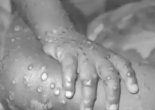 Ευλογιά των πιθήκων: Τα ύποπτα συμπτώματα του ιού σύμφωνα με τον ΕΟΔΥ