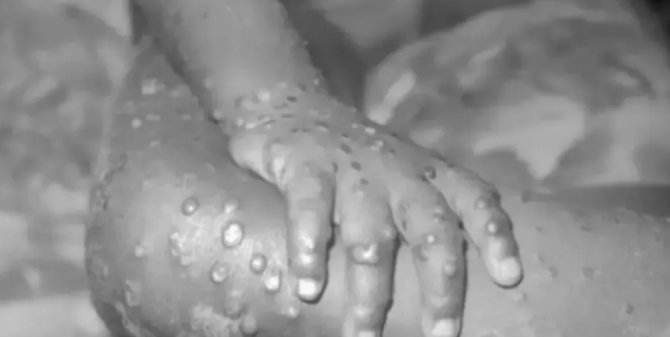 Ευλογιά των πιθήκων: Τα ύποπτα συμπτώματα του ιού σύμφωνα με τον ΕΟΔΥ Ευλογιά των πιθήκων: Τα ύποπτα συμπτώματα του ιού σύμφωνα με τον ΕΟΔΥ